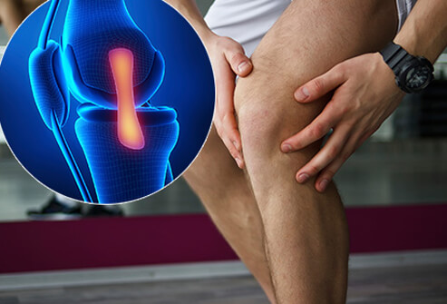 fájdalom húzása a térd alatt a kezelés mögül ízületek rheumatoid arthritisben