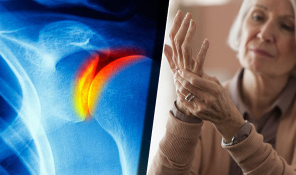 rheumatoid arthritis ízületi károsodás)