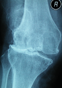 a láb osteoarthritisének kezelése a térd ízületi gyulladása