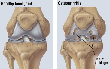 A térd osteoarthritis kezelését okozza - Arthrózis (porckopás) tünetei és kezelése