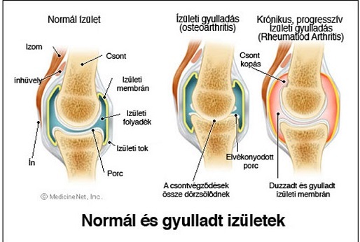 a bal térdízület ízületi gyulladása